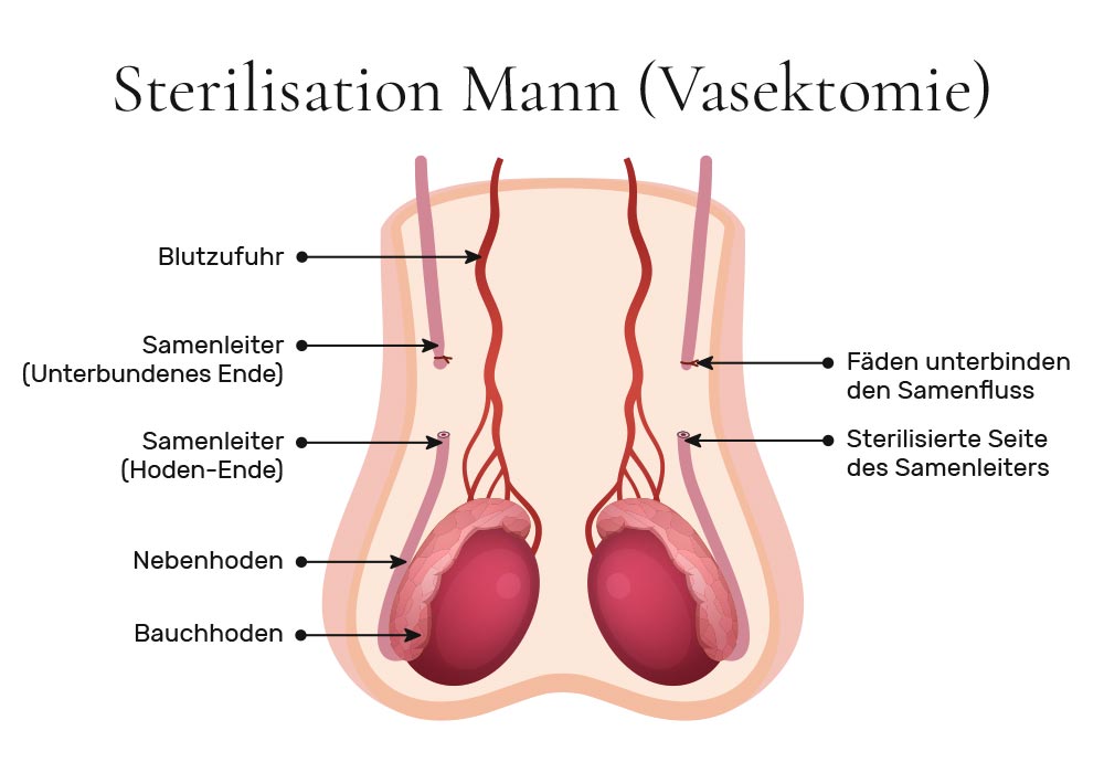 Sterilisation Mann