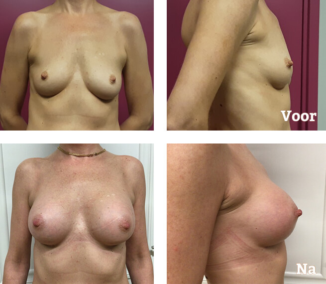 Brustvergrößerung mit Implantaten