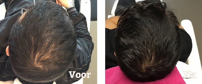 Mesotherapie Haare Vorher-Nachher